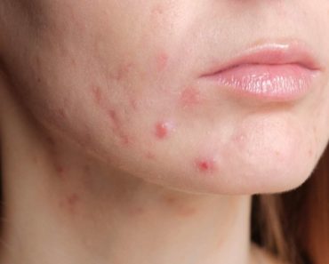 Pregnancy acne: Treatments and home remedies