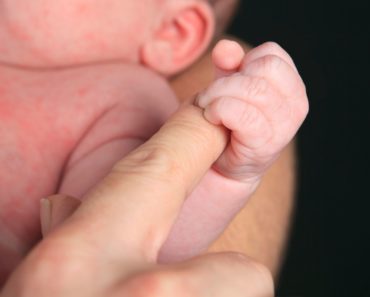 Erythema toxicum is a common newborn rash. Here’s how to manage it.