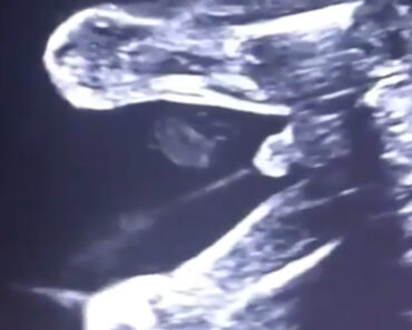 This ultrasound caught a baby peeing in utero