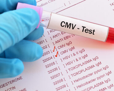 CMV (Cytomegalovirus) In Babies: Causes, Symptoms & Treatment