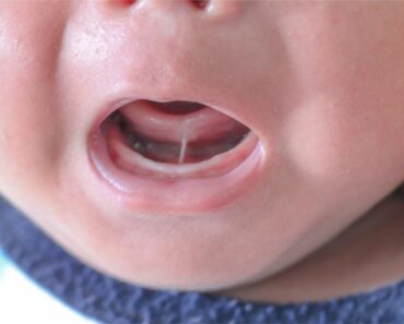 Tongue-tie In Babies: Symptoms, Causes And Treatment