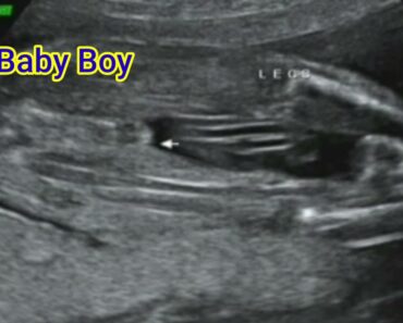 #shorts |Baby Boy in the womb| ultrasound baby boy in pregnancy | 100% scanning లో బాబు ఇలానే ఉంటాడు
