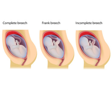 7 Common Breech Baby Birth Defects And How To Prevent Them