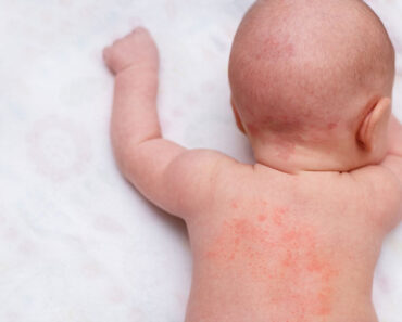 Anaphylaxis In Babies: Symptoms, Causes And Treatment
