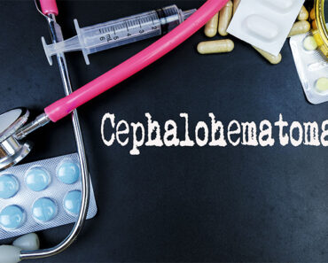 Cephalohematoma In Newborns: Symptoms, Causes And Treatment