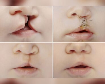 What Causes Cleft Lip And Palate In Babies And Treatment