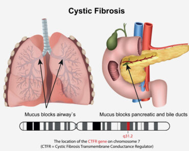 Cystic Fibrosis In Babies: Causes, Symptoms And Treatment