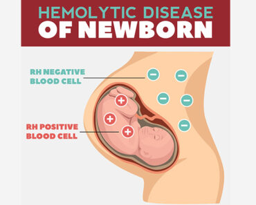Hemolytic Disease of the Newborn (HDN): Causes And Treatment