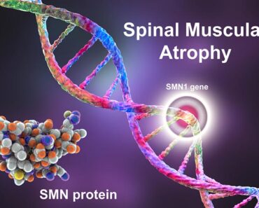 SMA (Spinal Muscular Atrophy) in Babies: Causes And Treatment