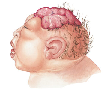 Anencephaly In Babies: Causes, Symptoms And Treatment