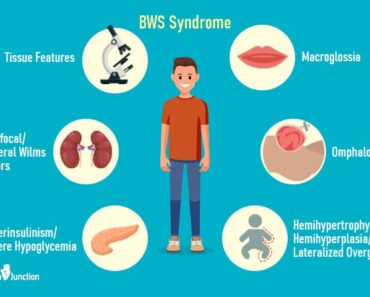 Beckwith-Wiedemann Syndrome: Symptoms, Causes And Treatment