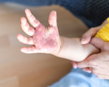 8 Treatment Options And Home Remedies For Burns In Children