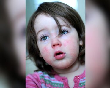 Scarlet Fever In Children: Symptoms, Causes, And Treatment