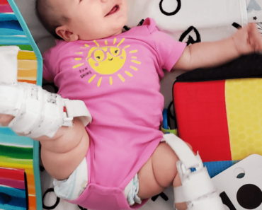 What is Hip Dysplasia? – Today’s Parent